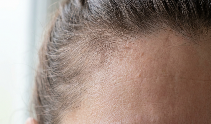 2. DHT doesn't just affect men. After menopause it becomes the single biggest driver of female hair loss.
